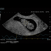 Automated Fetal Heart Rate