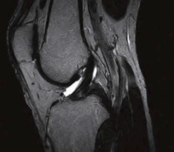Knee - Sagittal T2 FSE scan with high resolution acquisition and reconstruction matrix and thin slices shows slightly injured ASL ligament and all details of anatomy of the joint