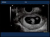 Embryo and yolk sac