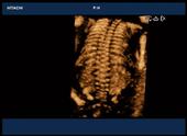 3D image of fetal spine