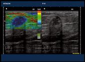 An invasive ductal carcinoma