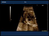 Detail of fetal heart