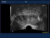 Bicornuate uterus