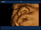 3D image of fetal face