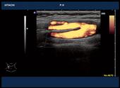 Carotid artery bifurcation