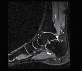 Foot - Saggital T2 FatSepFSE provides homogenous fat supression for confident imaging results