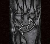 Wrist - Coronal T2 * Gradient Echo the lateral patient table enables easy positioning and optimal image quality 