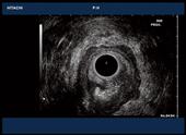 Rectal tumor