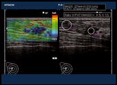 HI-RTE of the breast