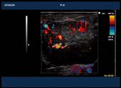 Focal nodular hyperplasia