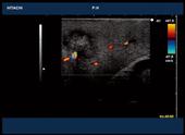 Intraoperative scan