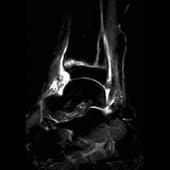 Ankle - STIR Sagittal scan shows fracture and small bone edemas. The wide range of fat suppression techniques is available on AIRIS Light MSK
