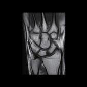 Wrist - Coronal T1 SE - Excellent T1 contrast using dedicated receiver coils allow high resolution scanning, detecting small changes in bone, cartilage and ligaments