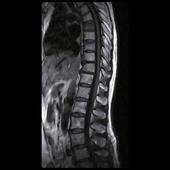 Thoracic Spine - Sagittal T1 SE - Large 350mm field of view allows complete thoracic spine visualization