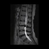 Lumbar Spine - Sagittal T2 FSE - Large disc herniation on level L2/L3 , with dehydration of the intervertebral disc