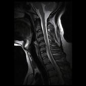 Cervical Spine - Sagittal T2 FSE scan clearly shows spinal cord compression in C5/C6 level