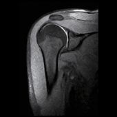 Shoulder - Coronal T1 WFS - Fat Water Separation technique provides images with fat signal separated in SE, GE and FSE sequences