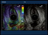 Horseshoe fistula