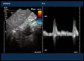 Transhepatic duplex scan