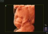 24 week fetus - 4DShading