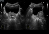Adult bladder with enlarged prostate gland