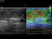 RTE - benign breast lesion
