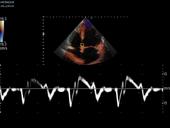 TDI with Doppler spectral trace