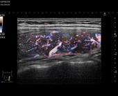 eFlow in thyroid lobe