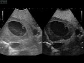 Contrast enhanced ultrasound of large liver tumour