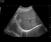 Small liver haemangioma
