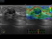 RTE - benign breast lesion