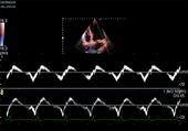 Dual Gate Doppler, combination of TDI with blood flow