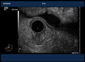 Esophageal tumor