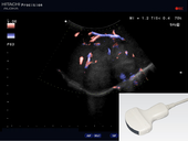 Large liver tumor and its blood supply 
