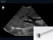 Hepatocellular carcinoma (HCC) 