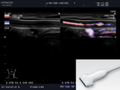 Carotid Artery Stenosis 