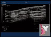 Radial Ductal Echography