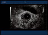 Rectal fistula