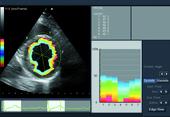 A-SMA - Automated Segmental Motion Analysis