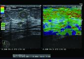 Breast with RTE Real-time Tissue Elastography
