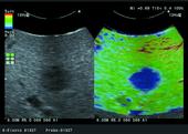 Intraoperative - Metastatic hepatic cancer with RTE Real-time Tissue Elastography