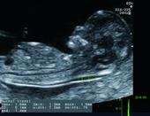 AutoNT - Automated Nuchal Translucency Measurement