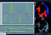 TDI - Tissue Doppler Imaging Analysis