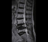 Lumbar Spine - Sagittal T2 FSE - Large 350mm field of view allows complete lumbar and sacral spine visualization