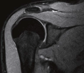 Shoulder - Coronal T2 WFS (Fat Water Separation) technique provides images with fat signal separated in SE, GE and FSE sequences