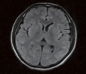 Brain - FLAIR axial scan with RADAR (Radial Acquisition Regime) motion compensation technique enables clear and motion-free imaging