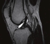 Knee - Sagittal T2 FSE scan with high resolution acquisition and reconstruction matrix and thin slices shows slightly injured ASL ligament and all details of anatomy of the joint