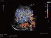 Contrast Harmonic Imaging Inflow Time Mapping (ITM)