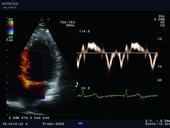 TDI - Tissue Doppler Imaging