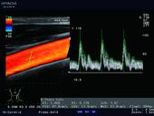 Auto Angle Correct measures blood flow with high accuracy